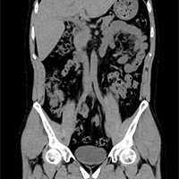 腹部 冠状断