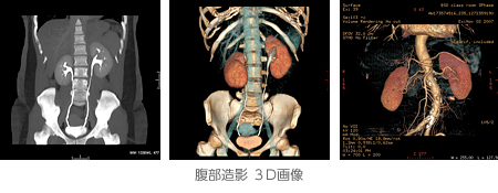 腹部造影 3D画像