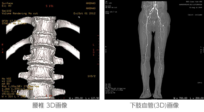 腰椎3D画像 下肢血管（3D）画像