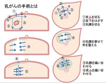 乳がん 手術 後 の 痛み